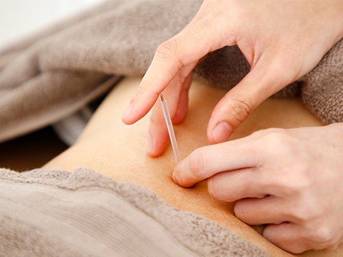 Acupuncture Services Acupuncture Services